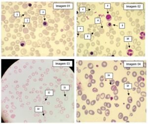 Hematologia Clinica 51/2024